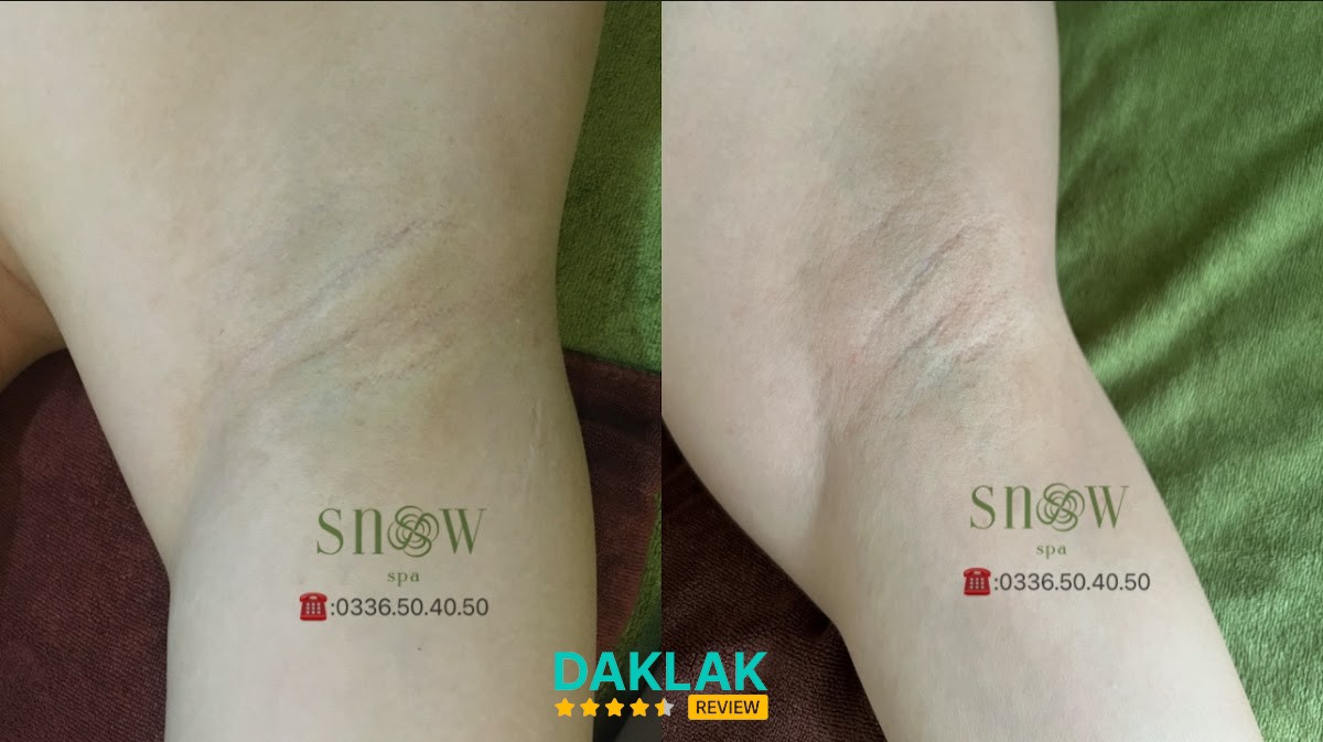 Snow Spa - spa trị mụn Tân An - hình 2